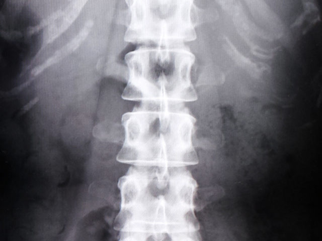 脊柱管狭窄症に手術は必要なのか？